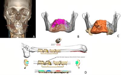 Frontiers | Mandibular Reconstruction With Fibula Flap And Dental ...